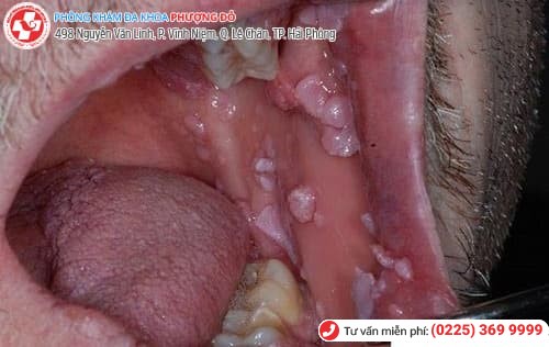 biểu hiện sùi mào gà ở miệng