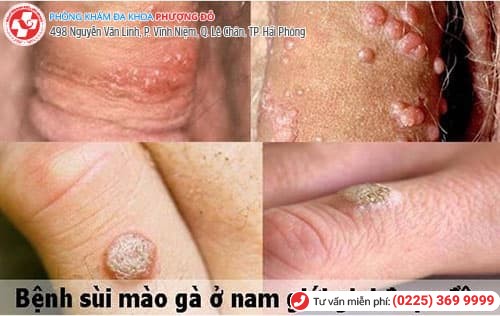 sùi mào gà giai đoạn đầu sùi mào gà giai đoạn đầu