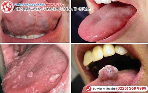 Bị sùi mào gà ở miệng vì quan hệ với trai trẻ Bị sùi mào gà ở miệng vì quan hệ với trai trẻ