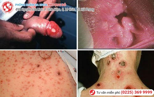 Những biến chứng khi mắc giang mai Những biến chứng khi mắc giang mai