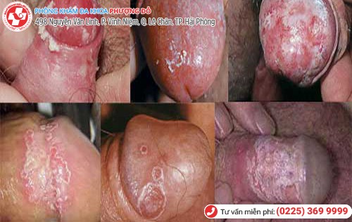 biến chứng mụn rộp sinh dục nam