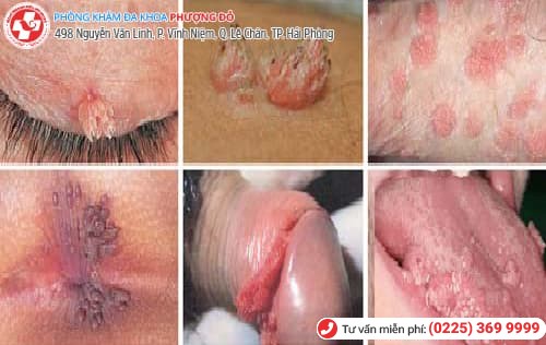 biến chứng sùi mào gà