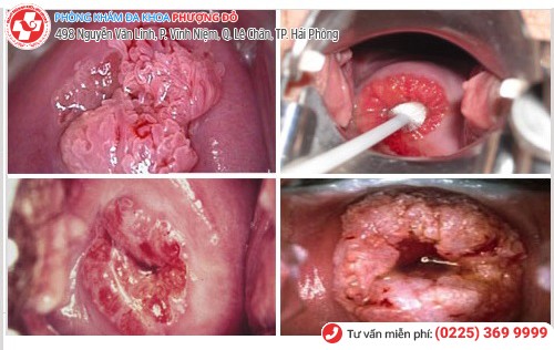 biến chứng sùi mào gà