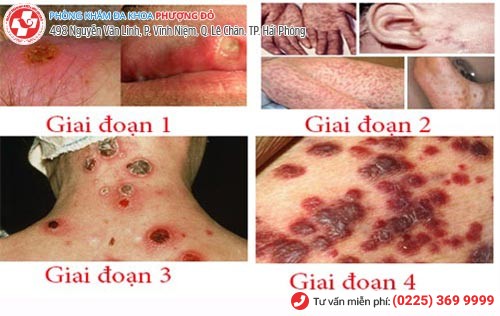 Biểu hiện bệnh giang mai qua các giai đoạn Biểu hiện bệnh giang mai qua các giai đoạn