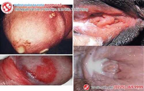 bệnh lây qua đường quan hệ tình dục