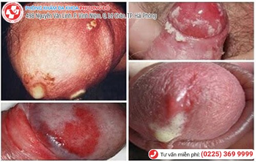 Bệnh lậu ở nam giới Bệnh lậu ở nam giới