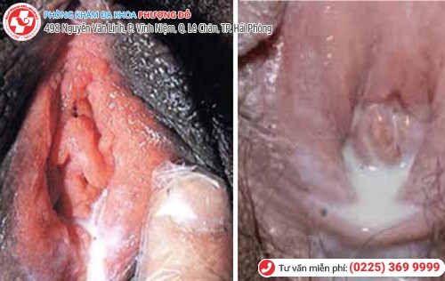 biểu hiện bệnh lậu ở nữ