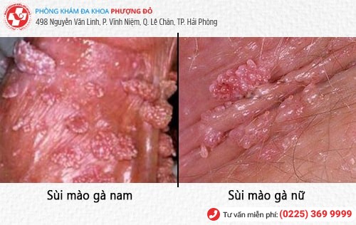 biểu hiện bệnh sùi mào gà biểu hiện bệnh sùi mào gà