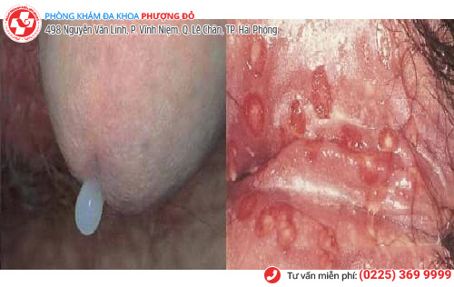 Tìm hiểu về các giai đoạn của bệnh lậu Tìm hiểu về các giai đoạn của bệnh lậu