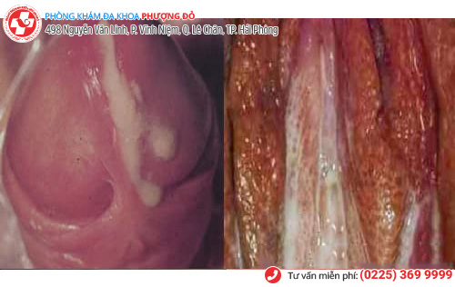 Tìm hiểu về các giai đoạn của bệnh lậu Tìm hiểu về các giai đoạn của bệnh lậu