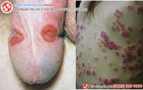 bệnh lây qua đường quan hệ tình dục