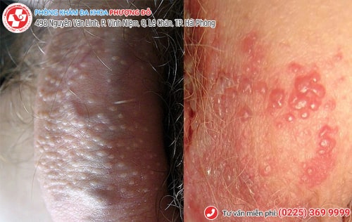 bệnh lây qua đường quan hệ tình dục