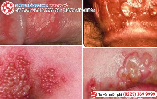biểu hiện mụn rộp sinh dục nam