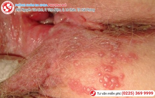 biểu hiện mụn rộp sinh dục nữ