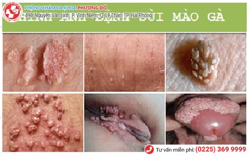 biểu hiện sùi mào gà