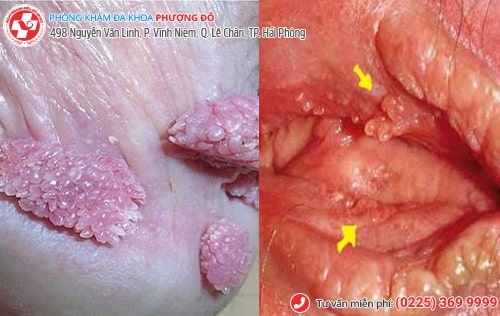 Bệnh lây qua đường quan hệ tình dục