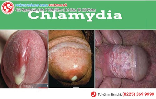 hình ảnh bênh chlammydia