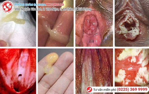 Nghi vấn âm đạo ra dịch vàng, âm đạo ra mủ vàng là bệnh lậu Âm đạo ra dịch vàng, âm đạo ra mủ vàng là bệnh lậu
