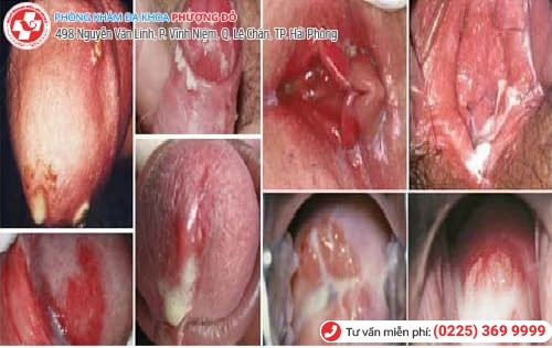 dấu hiệu bệnh lậu