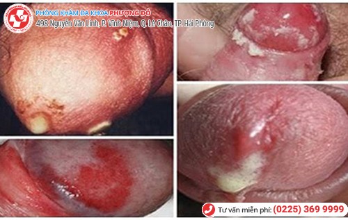 biểu hiện bệnh lậu ở nam