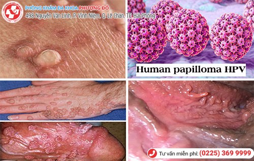 dấu hiệu mụn cóc sinh dục
