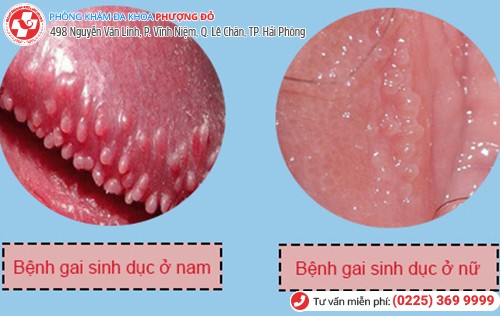 Hình ảnh gai sinh dục ở nam và nữ Hình ảnh gai sinh dục ở nam và nữ