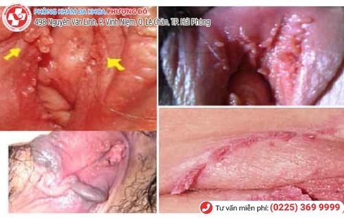 dấu hiệu sùi mào gà