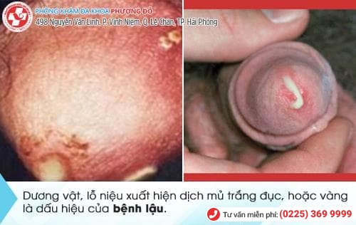 dương vật có mủ dương vật có mủ