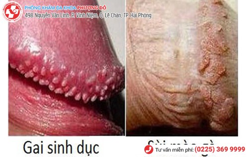 phân biệt gai sinh dục
