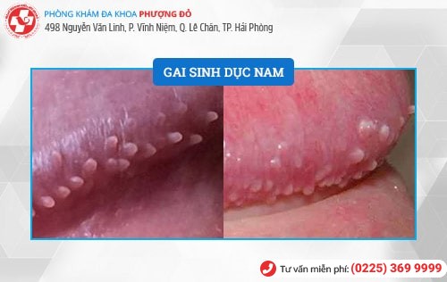 Hình ảnh gai sinh dục Hình ảnh gai sinh dục