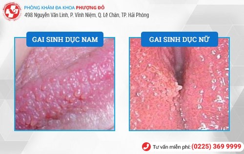 gai sinh dục gai sinh dục