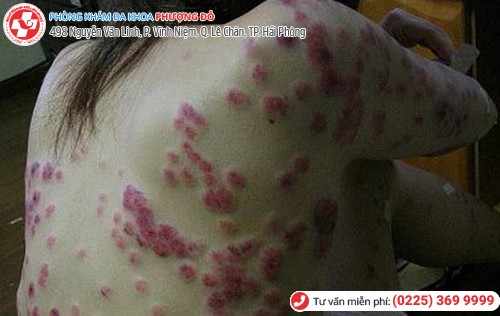 giang mai ở nữ giai đoạn 3