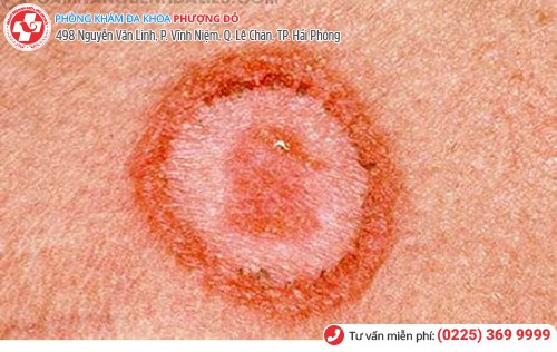 giang mai ở nữ giai đoạn 1