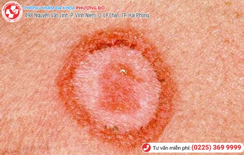 hình ảnh giang mai giai đoạn 1