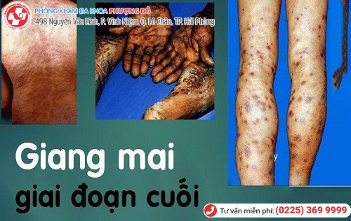 giang mai ở nam gđ3