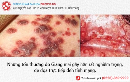 dấu hiệu giang mai bệnh xã hội