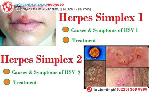 Hình ảnh Herpes sinh dục