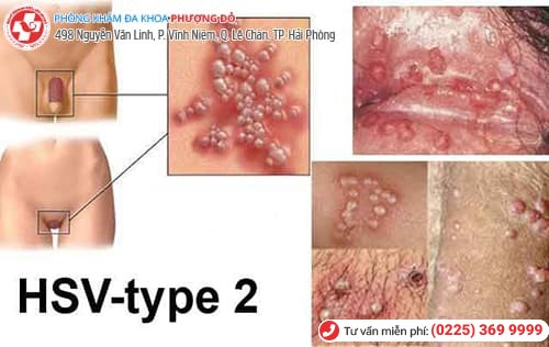 herpes sinh dục