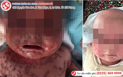 herpes sinh dục ở thai nhi