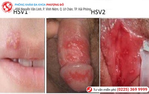 biểu hiện herpes sinh dục