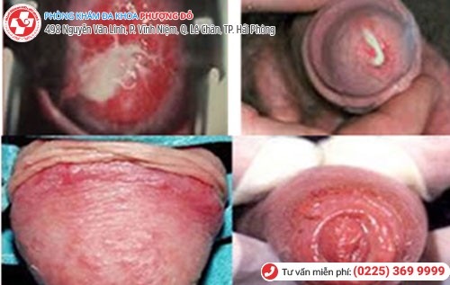 hình ảnh bệnh lậu