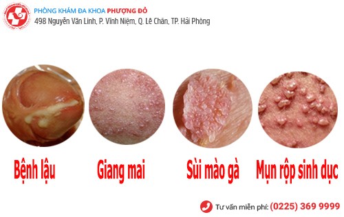 hình ảnh bệnh lây qua đường tình dục