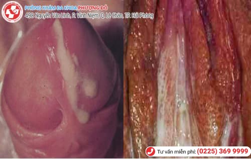 hình ảnh bệnh lậu mãn tính