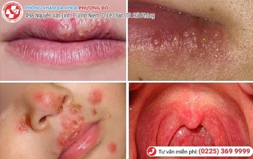 Mắc mụn rộp sinh dục vì nụ hôn của mẹ Mắc mụn rộp sinh dục vì nụ hôn của mẹ