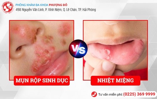 Mắc mụn rộp sinh dục vì nụ hôn của mẹ Mắc mụn rộp sinh dục vì nụ hôn của mẹ