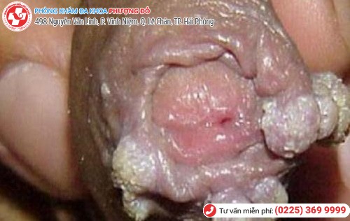 biểu hiện mụn cơm hoa liễu