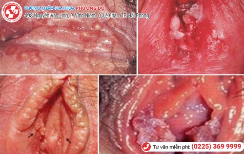 biểu hiện mụn môi dưới