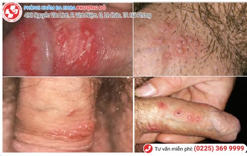 mụn rộp sinh dục nam