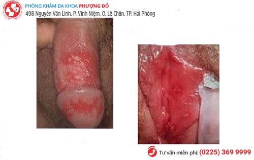 hình ảnh mụn rộp sinh dục