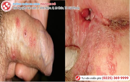 herpes sinh dục